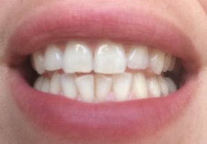 Dents_blanches_après