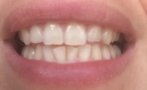 Dents_blanches_avant